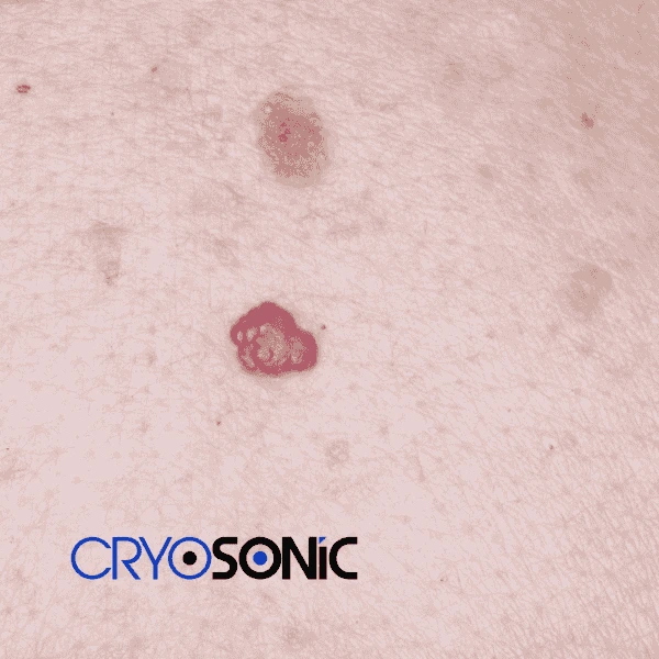 Looking for pain free cherry angioma removal treatment Worthing? Call our team today! Worthing