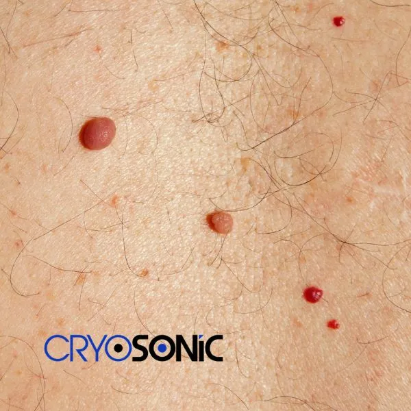 get cherry angioma removal treatment today! Worthing