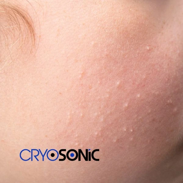 Are you looking for milia removal treatment? Contact our team today Worthing