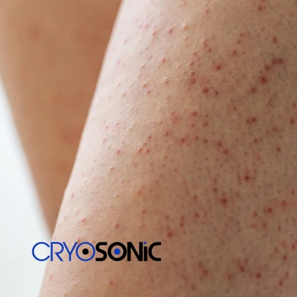 Looking for Seborrhoeic Keratosis removal Worthing treatment? Call our consultants today in Worthing