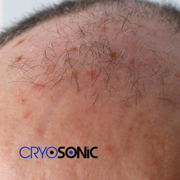 Access Seborrhoeic Keratosis removal from the comfort of your own home! Call us today in Worthing