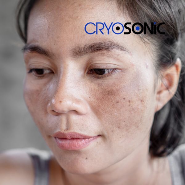 Ready to start age spots removal? Contact our team today in Worthing