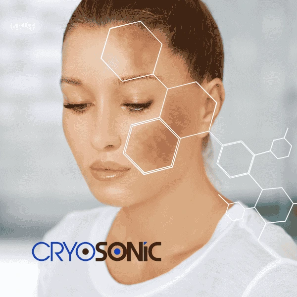 Are you looking for age spot removal treatment? Contact Cryosonic today in Worthing