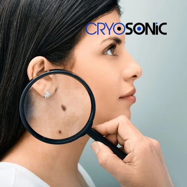 Do you want to learn more about benign moles removal treatment? Call our team today Worthing