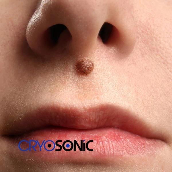 Start your benign moles removal treatment today Worthing
