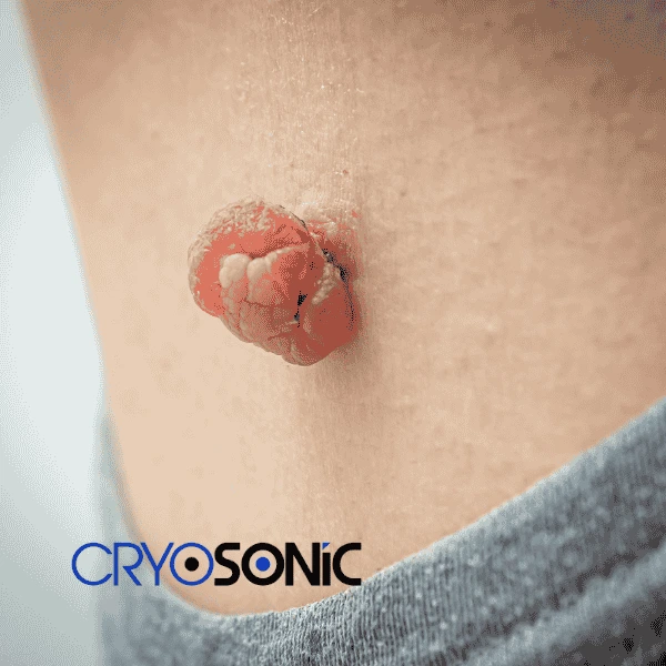 Book your skin tags removal Worthing from comfort of your own home! Worthing