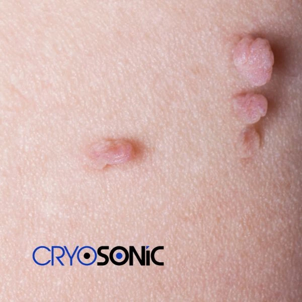 Are you looking for fast effect skin tag removal Worthing? Book in NOW! Worthing