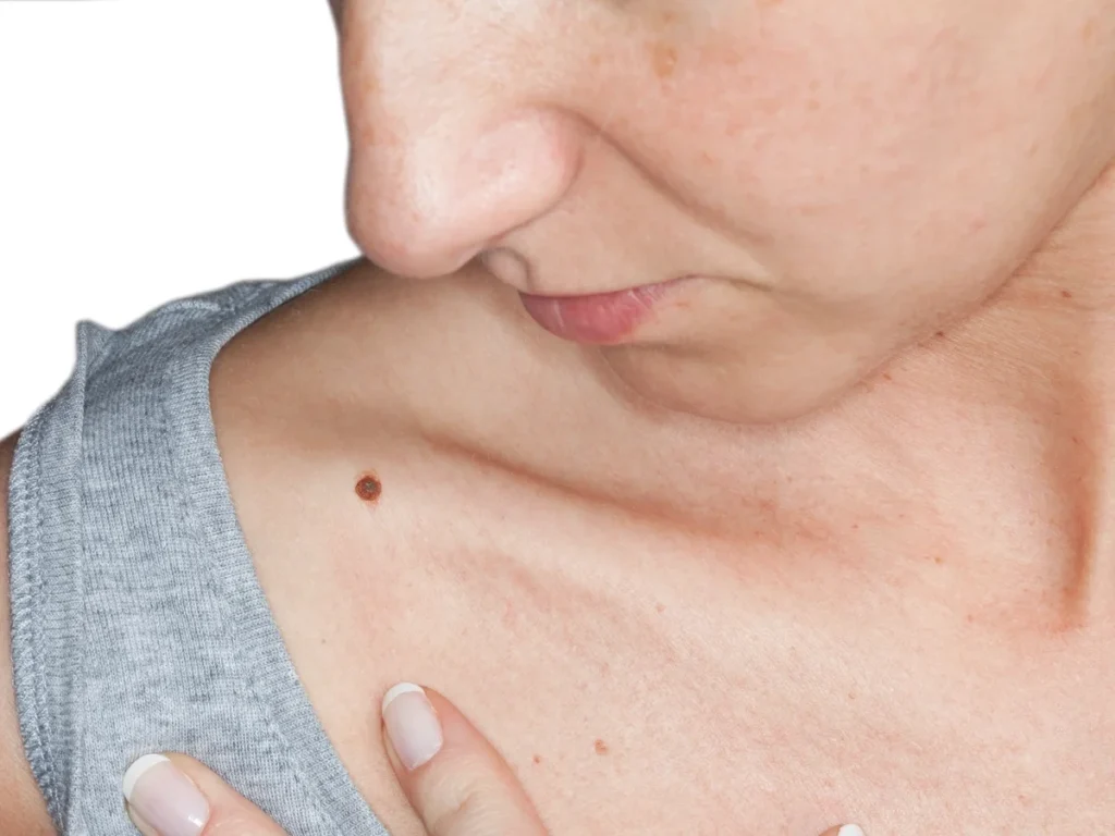 How Does CryoPen Sun Damage Treatment Worthing Work? Worthing