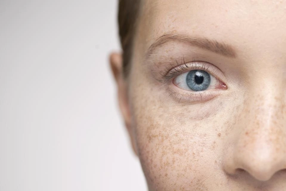 Understanding Sun Damage: How UV Rays Alter Skin and How CryoPen Can Reverse It Worthing