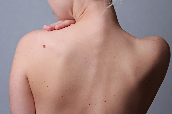 The Skin&rsquo;s Healing Journey After CryoPen Sun Damage Treatment Worthing