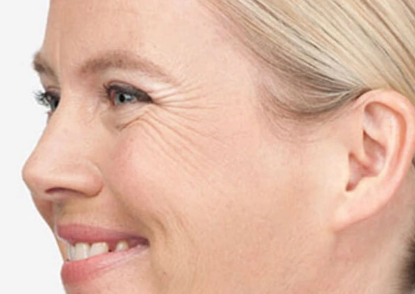 CryoPen Precision vs. Laser: Which Is Better for Sun-Damaged Skin? Worthing