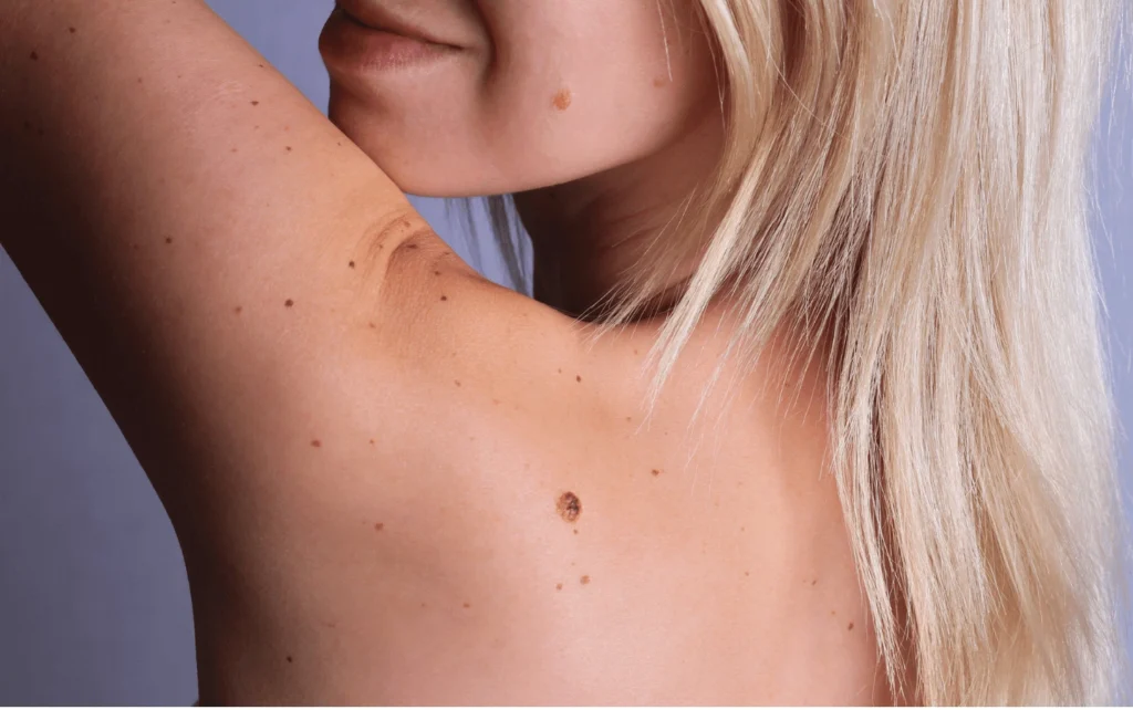 What Are Sun Spots and Pigmentation Worthing? Worthing