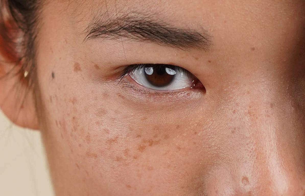 Is There Any Risk of Scarring or Pigmentation Worthing? Worthing