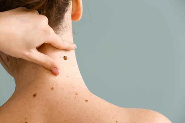 Who Should Avoid CryoPen Treatments? Worthing