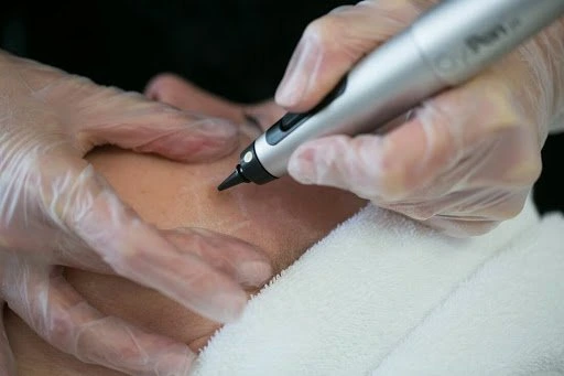 The CryoPen Technology Explained: How Extreme Cold Removes Sun-Damaged Skin Cells Worthing
