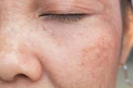CryoPen Precision vs. Laser: Are Both Treatments Safe? Worthing