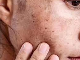 Why CryoPen Works Best for Isolated Sun Spots and Pigmentation Worthing