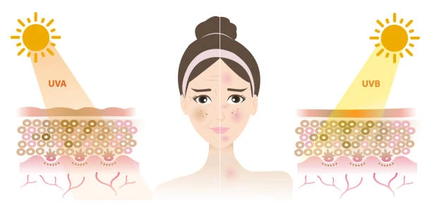 Understanding Sun Damage Worthing : How Do UV Rays Cause Changes in the Skin? Worthing