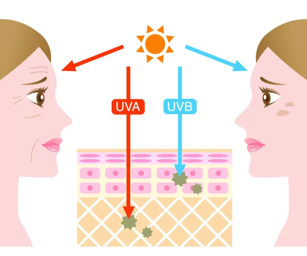 Understanding Sun Damage Worthing - Why Should Sun Damage Be Treated Early? Worthing